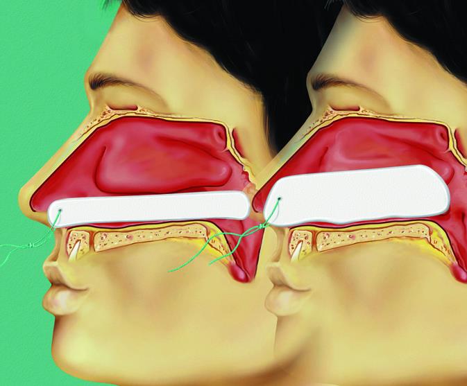 Raucocel Epistaxistampoande 100mm 10 Stk., steril, mit Faden